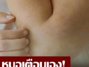 ควรระวัง!! ร่างกายมีอาการคัน 2 ส่วนนี้ อาจเป็นสัญญาณของ “มะเร็งตับ” ไม่ใช่อาการแพ้