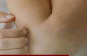 ควรระวัง!! ร่างกายมีอาการคัน 2 ส่วนนี้ อาจเป็นสัญญาณของ “มะเร็งตับ” ไม่ใช่อาการแพ้