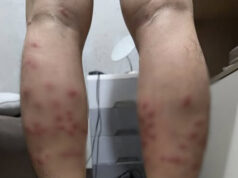 เตือน “ตัวคุ่น” แมลงจิ๋วพิษร้าย กัดแล้วคัน แผลลุกลามหนัก