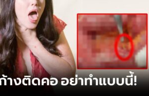 ความเชื่อผิดๆ “ก้างปลาติดคอ” หญิงกลืนข้าวดันลงท้อง สยองกว่าเดิมต้องทำ “ทวารเทียม”