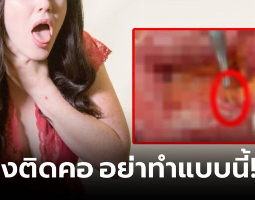 ความเชื่อผิดๆ “ก้างปลาติดคอ” หญิงกลืนข้าวดันลงท้อง สยองกว่าเดิมต้องทำ “ทวารเทียม”